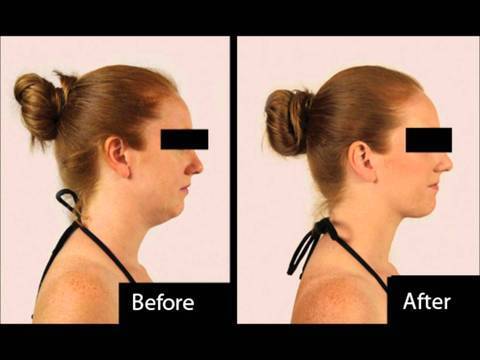 NECKLINE SLIMMER