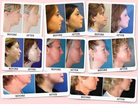 NECKLINE SLIMMER